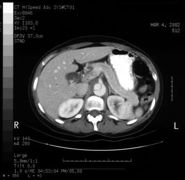 Aortic dissection. CT scan showing a flap (center 