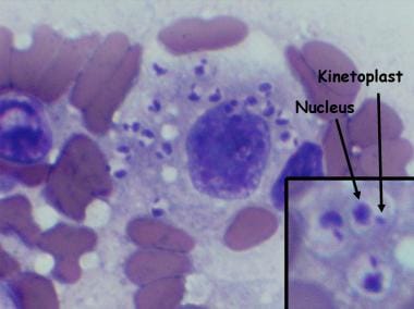 visceral leishmaniasis histology