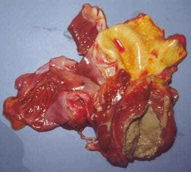 Myocardial abscess (opened). 