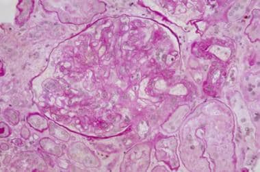 Photomicrograph of a kidney-biopsy sample in a cas