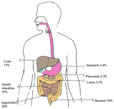 Intestinal Carcinoid Tumor: Practice Essentials, Background ...