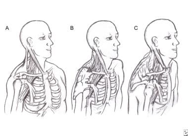 Thoracic outlet syndromes