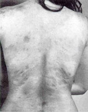 This photograph shows generalized morphea on the t
