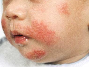 Irritation around mouth of an infant with atopic d