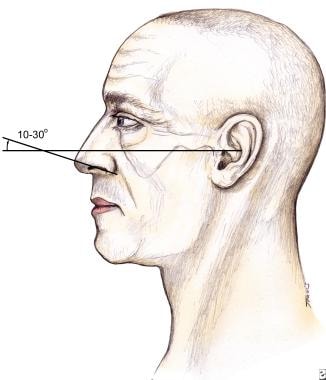 Rhinoplasty, tip ptosis. Nasal tip rotation can be