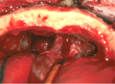 A cranial base resection with a view of the anteri