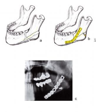 Comminuted angular fracture of the left mandible. 