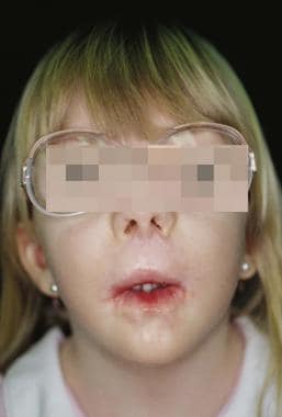 Child with Freeman-Sheldon syndrome. 