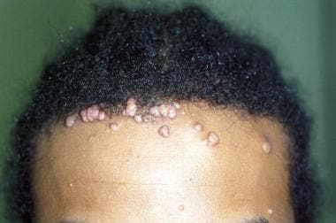 Molluscum contagiosum lesions in individuals infec