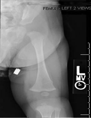 Acute distal femur buckle fracture; note absence o