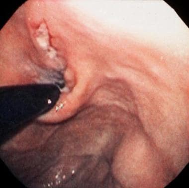Mallory-Weiss Syndrome. Retroflexed view of the ca