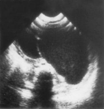 Ultrasound image demonstrating a thin-walled mesen