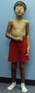 Child with Klinefelter syndrome. Other than a thin