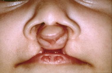 Cleft lip and cleft palate in an infant with van d