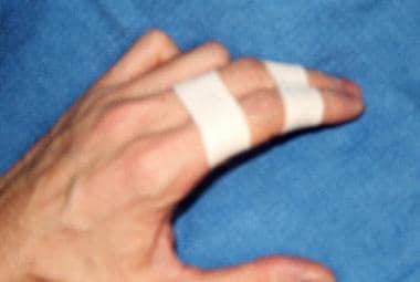 Finger Taping to Prevent Extension