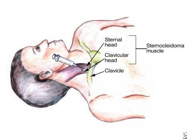 Percutaneous internal jugular venous access. Anato