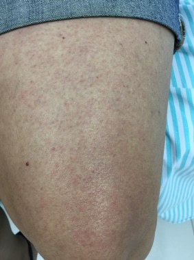 Rash in a patient with Zika virus infection. Court