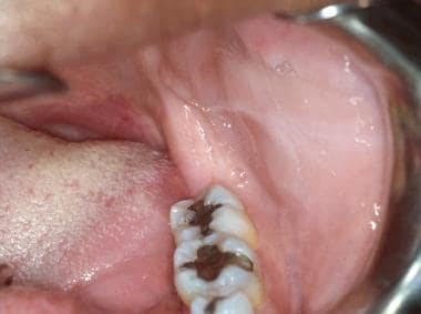The linea alba of the left buccal mucosa at the le