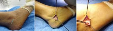 Peroneal Tendon Pathology Clinical Presentation: History, Physical