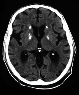 CT scan of a man who has Down syndrome confirmed b