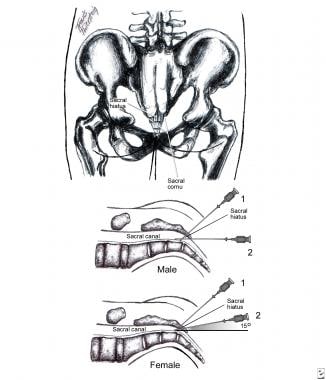 Caudal block technique. See text for details. 