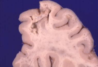 Toxoplasma gondii abscesses are seen on this brain