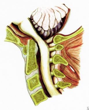 Rheumatoid spondylitis. Depiction of superior migr