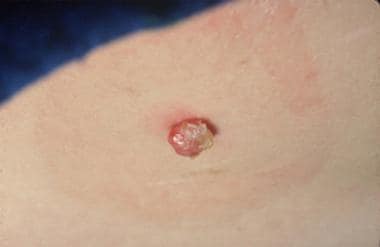Papular benign skin lesion: Pyogenic granuloma. 