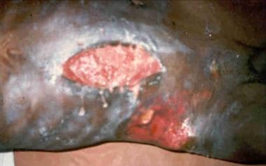 Enterocutaneous fistula with severe skin excoriati