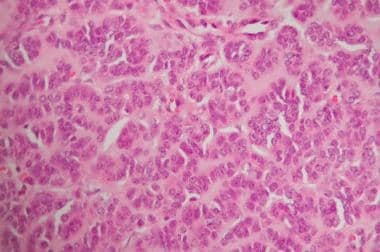 Sertoli cell tumor with characteristic arrangement