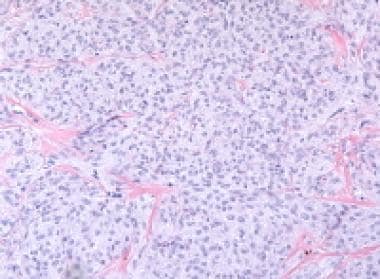 Thecoma. The tumor cells have abundant pale cytopl