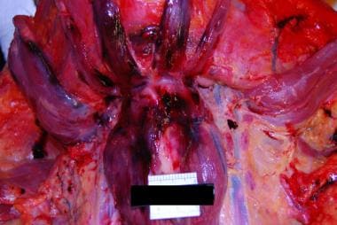 Anterior neck dissection demonstrating hemorrhage 