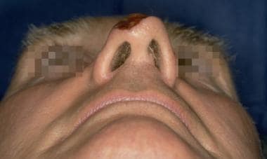 Case 3. Preoperative nasal defect. 
