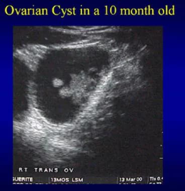 Ovarian Cyst 5cm