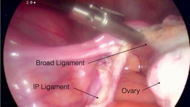 Zdjęcie laparoskopowe z laparoskopii Salpingo oophorectomy z zaznaczonymi punktami orientacyjnymi