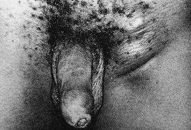 Lymphogranuloma venereum: large left inguinal bubo
