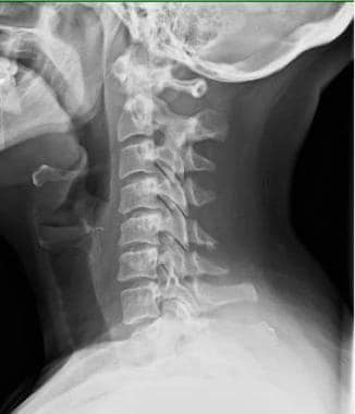 Lateral radiograph of cervical spine showing all 7