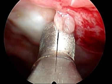 Biopsy forceps sampling parietal pleura. 