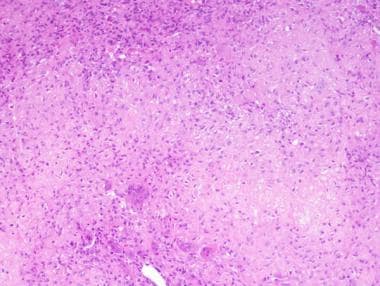 Chondroblastoma Workup: Imaging Studies, Tissue Diagnosis, Histologic ...