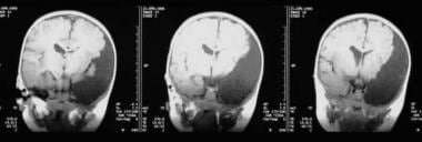 Postnatal coronal T1-weighted MRI images through t