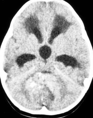 Case 1a. Ependymoma arising from the fourth ventri