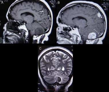 Multiple meningiomas. A: Sagittal T1-weighted magn