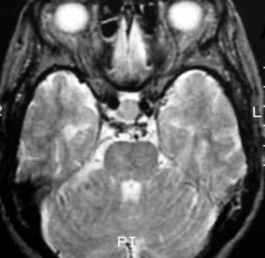 T2-weighted axial image shows the mass, a Rathke c