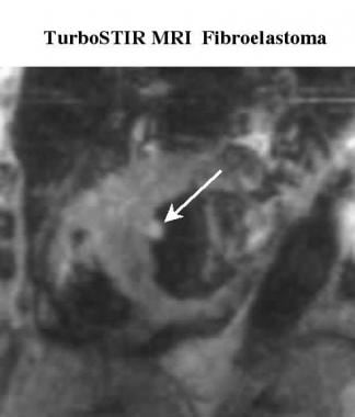 Turbo short-tau inversion recovery short-axis MRI 