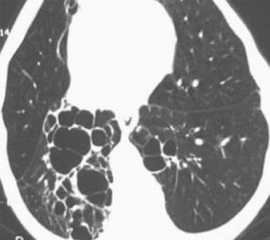 HRCT scan in a 75-year-old man with cystic bronchi