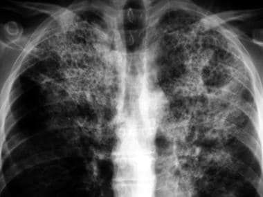 A magnified view of lung apices from a patient wit