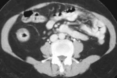 Crohn disease. Fibrofatty proliferation. CT scan i