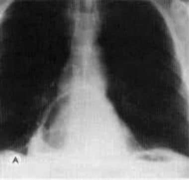 Frontal chest image shows 2 air-fluid levels, 1 be