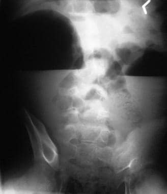 This erect radiograph shows fluid levels in the si