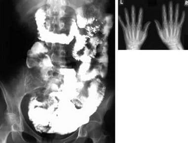 Three-hour image from a small bowel study shows ir